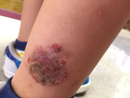 치료 2주 후 - 진물 멈추고 상처 딱지 생김