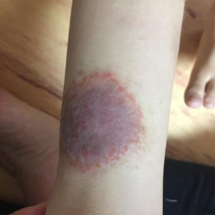 치료 1개월 후 - 상처 딱지 떨어지고 흉터 옅어짐