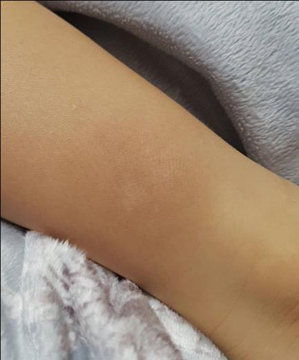 치료 3개월 후 - 희미한 자국만 남음