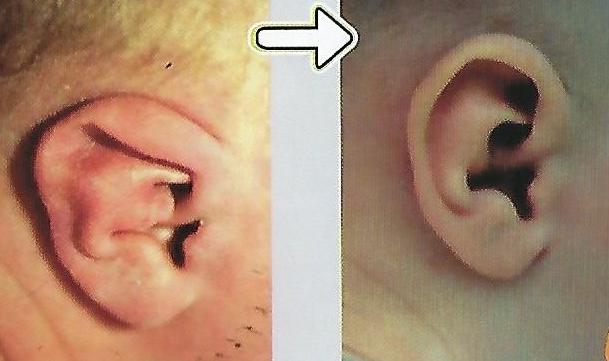 구겨진귀 교정 전후