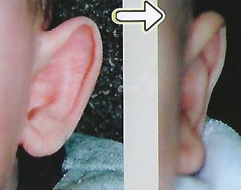 당나귀 귀 교정 전후