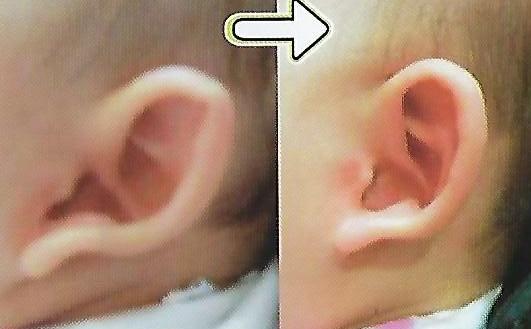 돌출귀 교정 전후