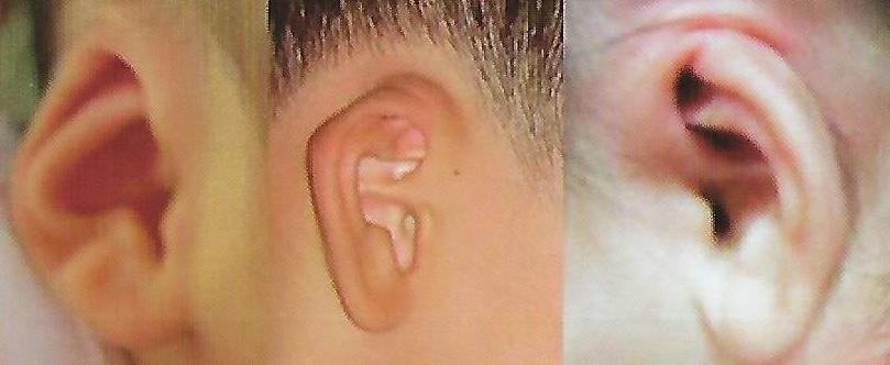 매몰귀 교정 사례