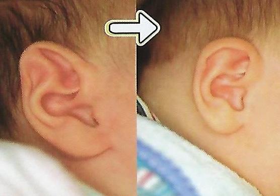 박쥐귀 교정 전후