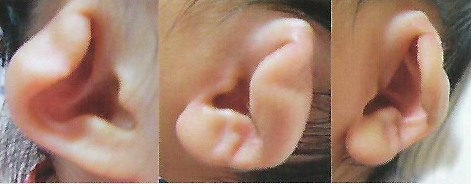 접힌귀/컵귀/오그라진귀 교정 사례